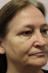 Vampire Facial 3 - Before Treatment